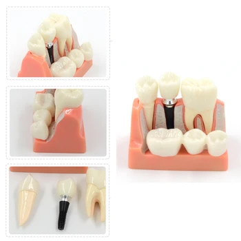 Дентален модел 4 пъти Анализ на зъбни импланти Демонстрация на Crown Bridge Модел на зъбни зъби Стоматолог Преподаване Стоматологична клиника
